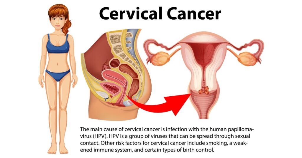 cervical cancer